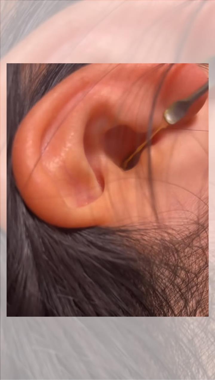 耳垢偏濕偏油狀態照片